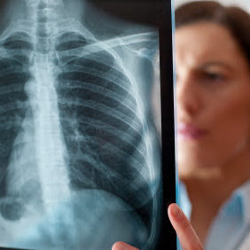 Female doctor looking at a lungs or torso xray